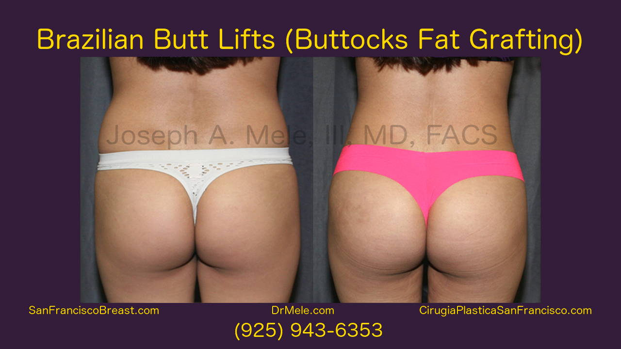 Brazilian Butt Lift Video with Buttocks Fat Grating Before and After Pictures