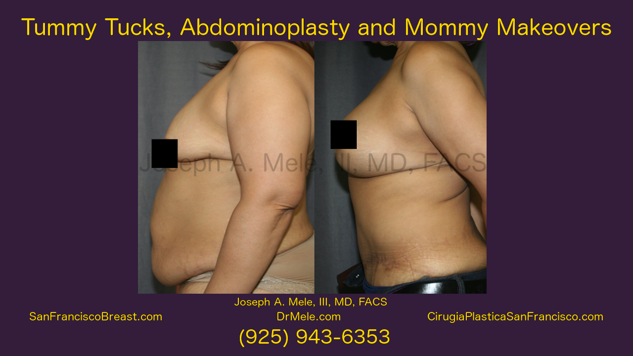 Mommy Makeover Video Presentation with Breast and Belly Enhancement Before and After Pictures