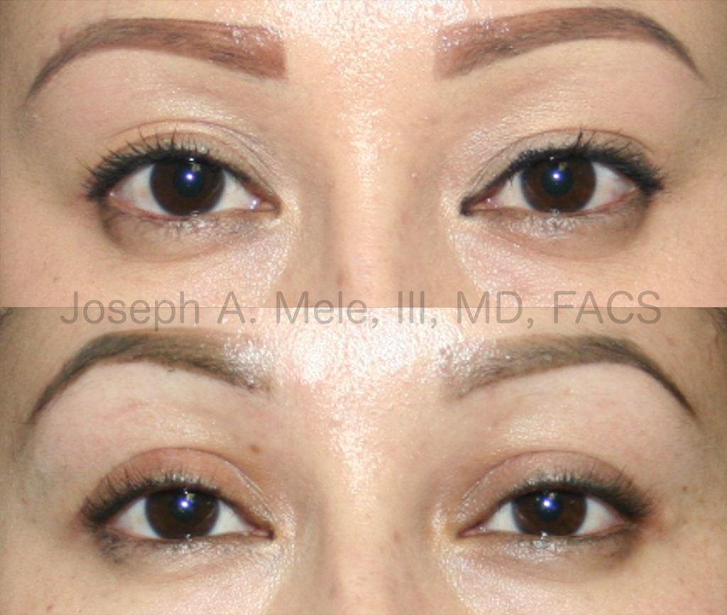 Blepharoplasty San Francisco Plastic Surgery Blog