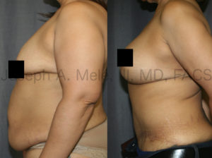 The Tummy Tuck is half of a Mommy Makeover. The woman above wanted her pre baby belly and breast back. The combination of Abdominoplasty and Breast Augmentation with a Breast Lift restored what nature had given and taken away.