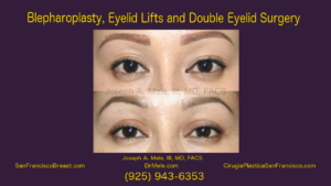 Eyelid Lifts and Double Eyelid Surgery Video Presentation with Before and After Photos