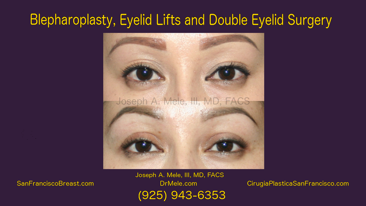 Eyelid Lifts and Double Eyelid Surgery Video Presentation with Before and After Photos