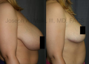 The above Breast Reduction Before and After Side View shows the improvement in shape and nipple location as well as the reduction is size after Reduction Mammoplasty.