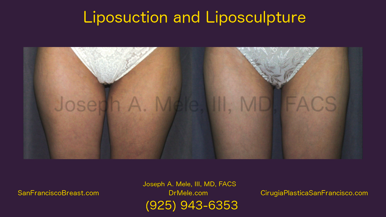 Liposuction Video with Before and After Pictures