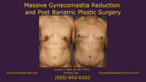 Post Bariatric Plastic Surgery Massive Gynecomastia Reduction Video with Before and After Pictures