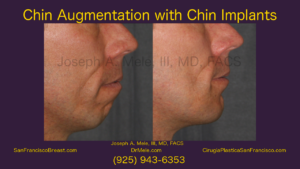 Chin Augmentation Video with Chin Implant Before and After Photos