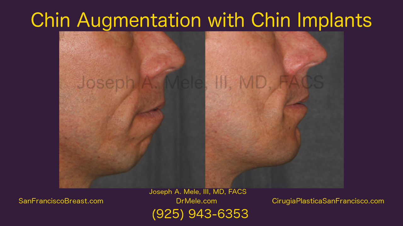 Chin Augmentation Video with Chin Implant Before and After Photos