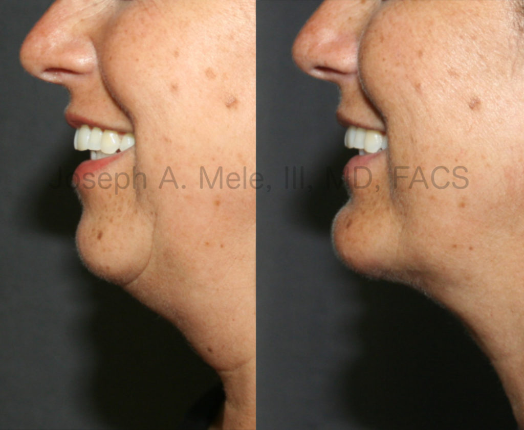 Chin Implants provide stable Chin Augmentation. In the above Chin Implant before and after pictures the patient is smiling. Even with animation, the enhanced projection is maintained and the definition of the neck line is clearly defined. In cases where there is disproportionate fat of the neck, Chin Augmentation can be combined with Neck Liposuction to further enhance your profile.