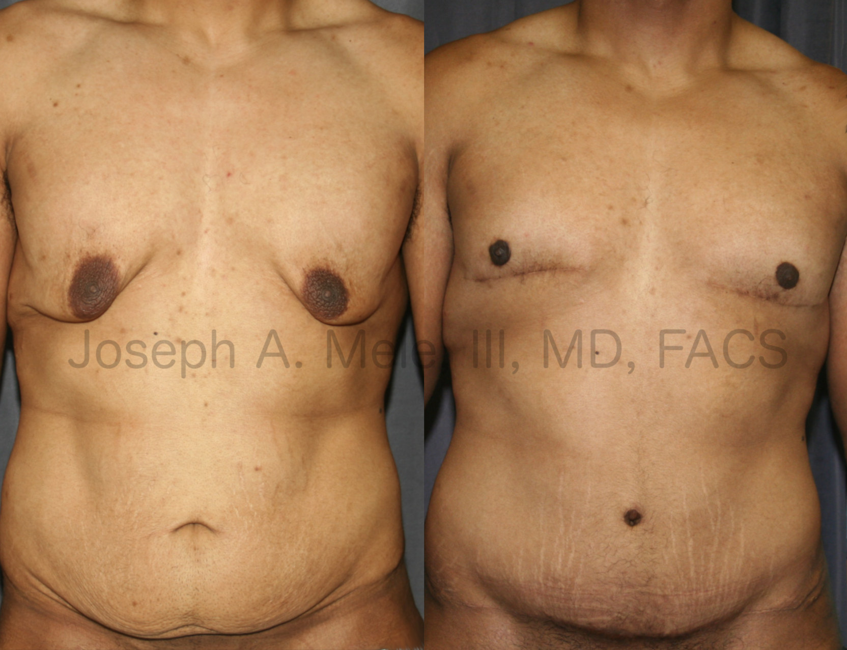 Gynecomastia Reduction after Massive Weight Loss is a different operation than the typical gynecomastia reduction. The large amount of excess skin and extremely low nipple position need special treatment. This patient had chest skin reduction (a male breast lift), reduction and repositioning of his nipples and a tummy tuck to clean up after his impressive weight loss.