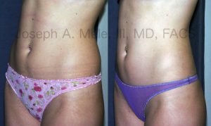 Liposuction Before and After Pictures