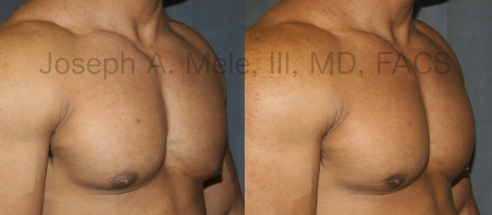 Liposuction can be used for male gynecomastia reduction in selected cases. If the fullness beneath the nipple is fat, liposuction can help. If it is glandular tissue, direct excision of the gland is needed.