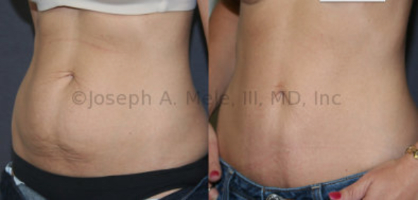 Sometimes a Mini Tummy Tuck is just what the doctor ordered. When the stretching and fullness is confined to the lower abdomen, a mini tummy tuck might just do the trick.