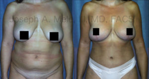 This Mommy Makeover combined a Breast Augmentation Lift with a Tummy Tuck and Liposuction.