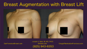 Breast Augmentation with Breast Lift Video with Mastopexy Augmentation Before and After Pictures