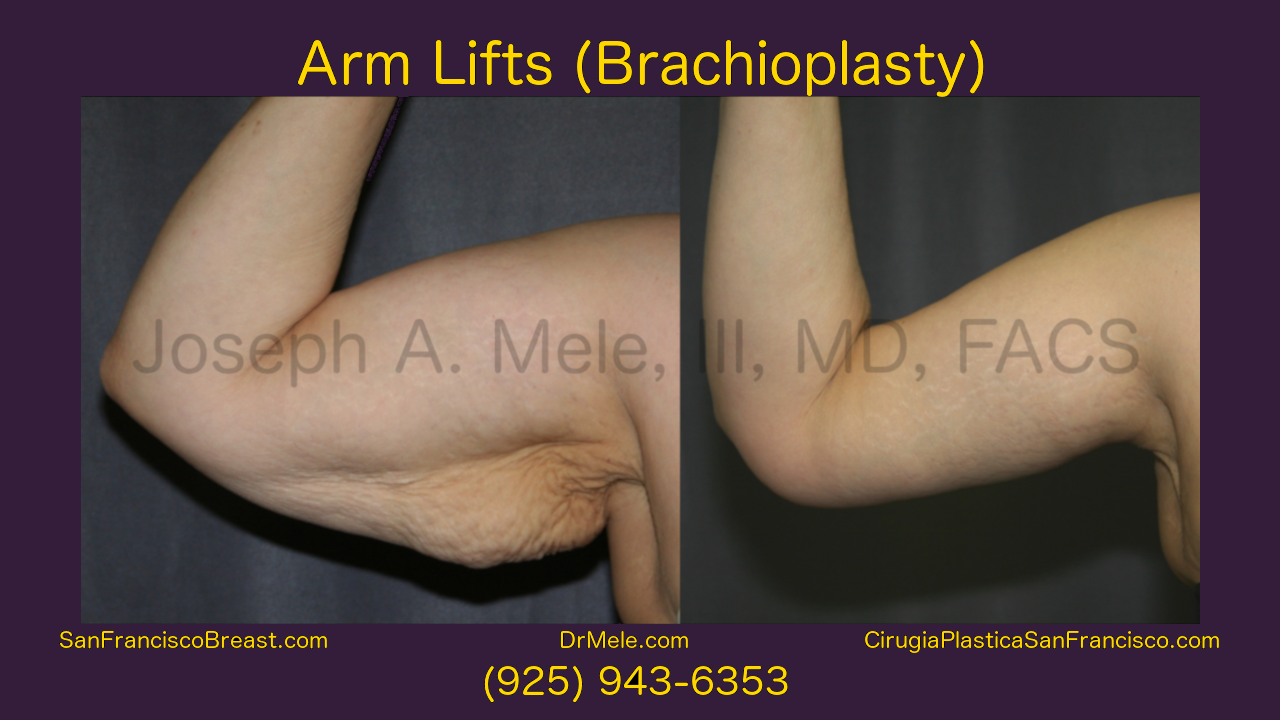 Arm Lift (Brachioplasty) Video with Before and After Photos