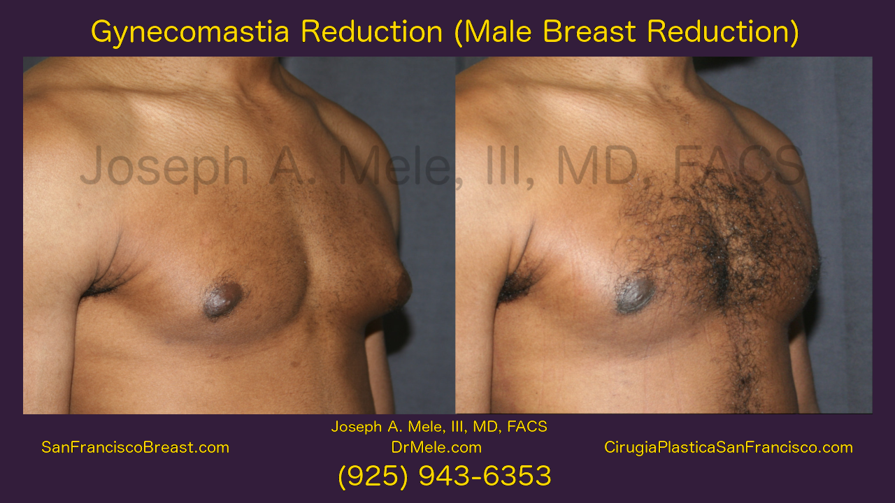 Gynecomastia Reduction Video with Male Breast Reduction Before and After Photos