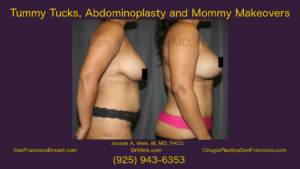 Tummy Tuck (Abdominoplasty) and Mommy Makeover Video with Before and After Pictures