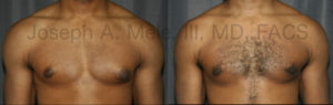 Before and after pictures of Gynecomastia Reduction for male breast enlargement.