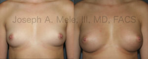 Breast Augmentation Before and After - Front View