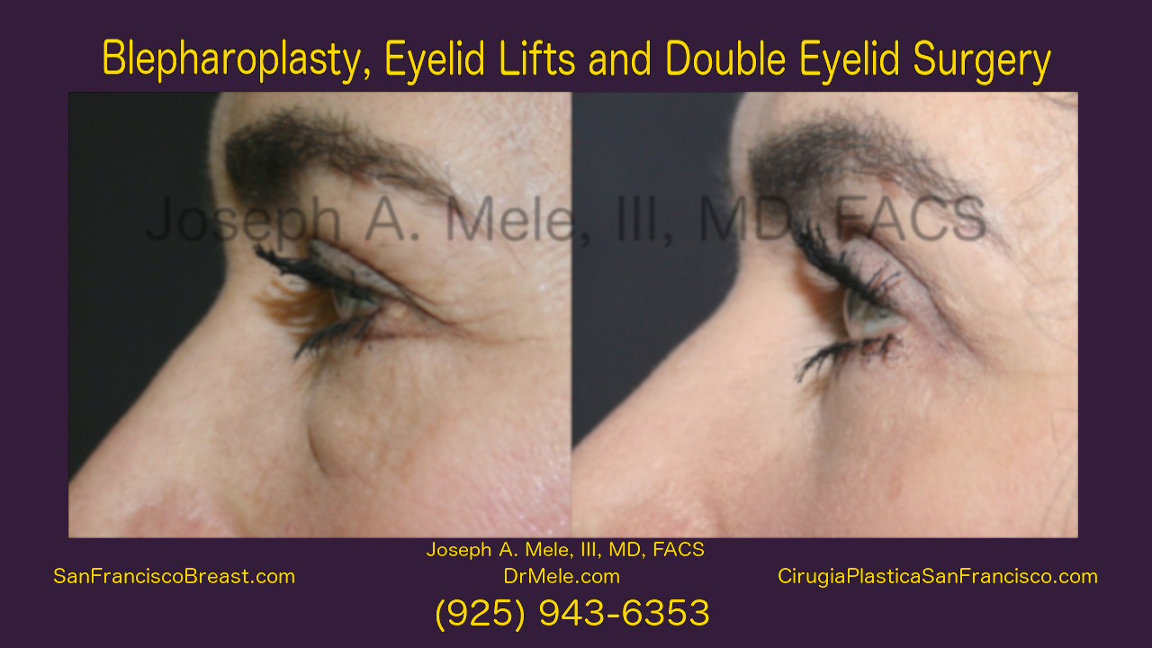 Cosmetic Eyelid Surgery Video (Blepharoplasty) with Before and After Pictures