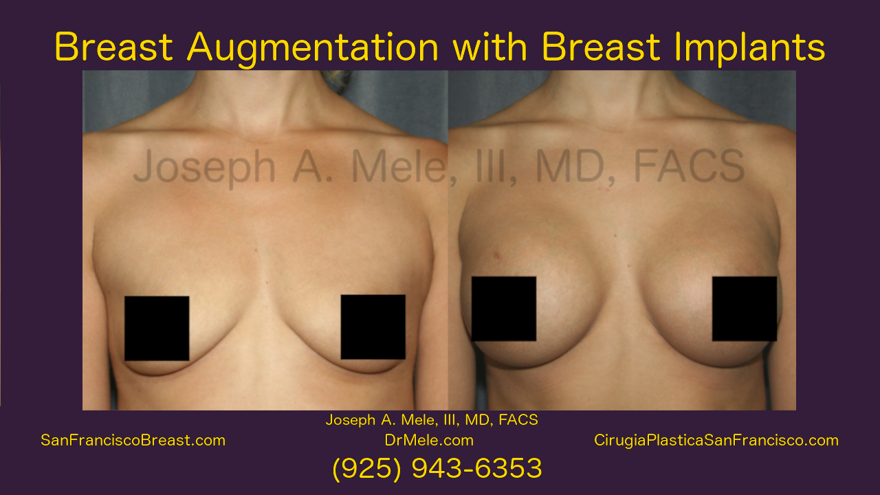 Breast Augmentation Video Presentation