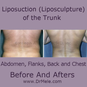 Liposuction of the Trunk (Abdomen, Flanks Back and Chest)