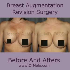 Breast Augmentation Revision Surgery before and after pictures