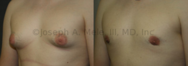 Chest Reduction Before and After Pictures (Men)