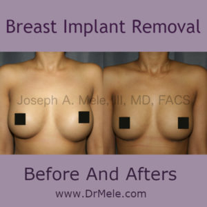 Breast Implant Removal Before and After Pictures