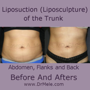 Liposuction Before and After Pictures