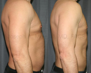 Liposuction of the Abdomen and Chest before and after pictures