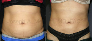 Liposuction of the Abdomen Before And After Pictures