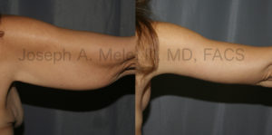 Arm lift before and after pictures