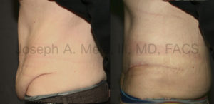 Tummy Tuck after weight loss before and after pictures