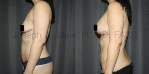 Mommy Makeover before and after photos