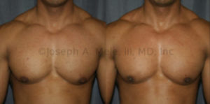 Gynecomastia Reduction before and after photos - Male Body Builder