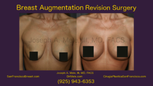 Breast Implant Revision Video with Breast Augmentation Revision Before and After Pictures