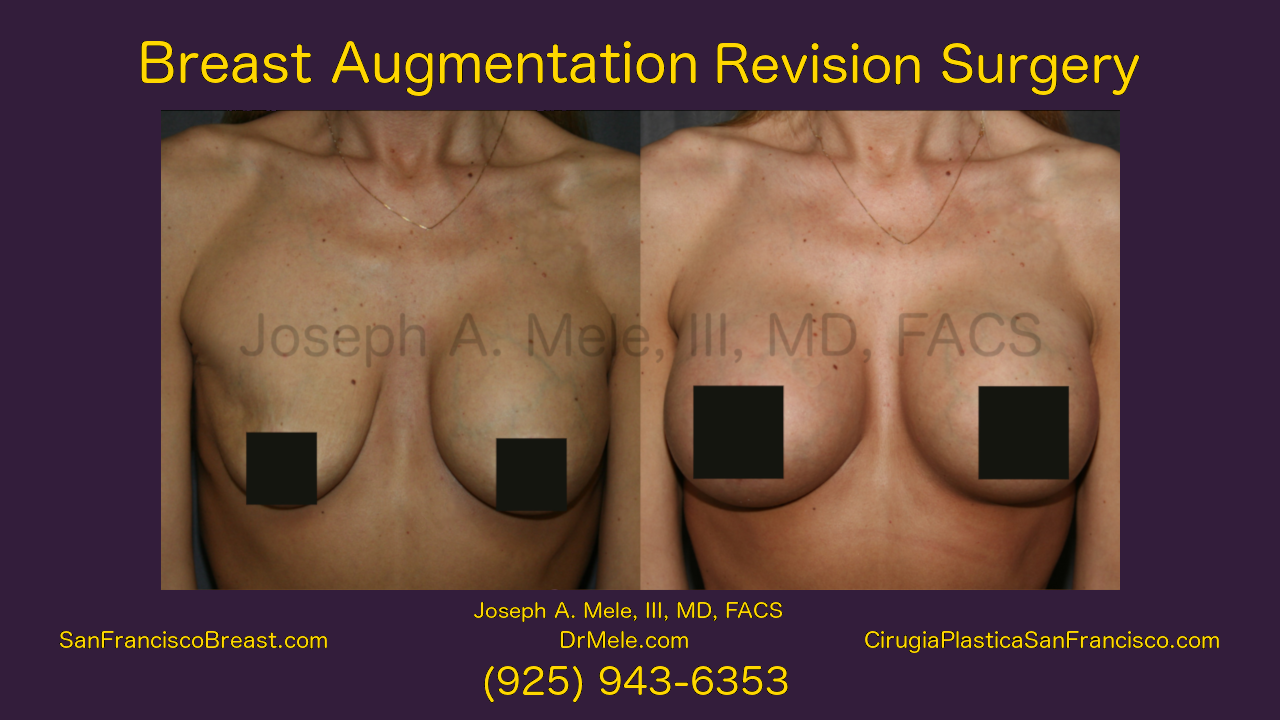 Breast Implant Revision Video with Breast Augmentation Revision Before and After Pictures