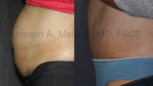 Tummy Tuck before and after pictures (Abdominoplasty)