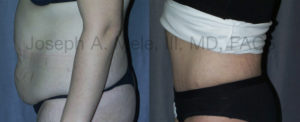 Tummy Tuck before and after pictures (Abdominoplasty)
