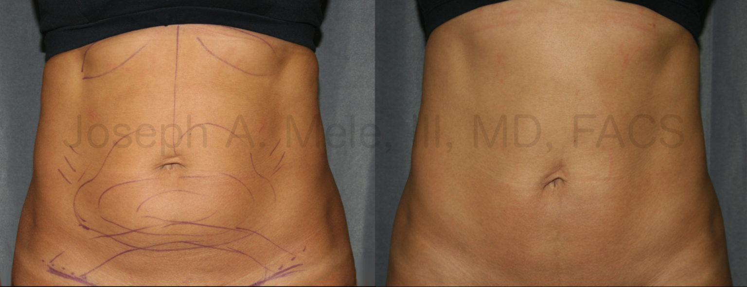 Tummy Tucks and Abdominoplasty