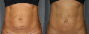 Mini Tummy Tuck before and after pictures (Mini Abdominoplasty)