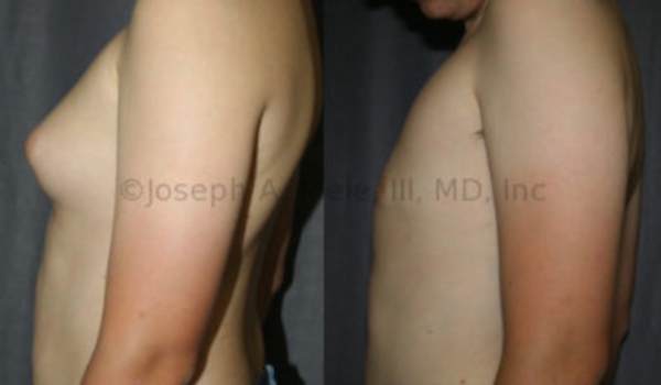 Gynecomastia Reduction - before and after pictures