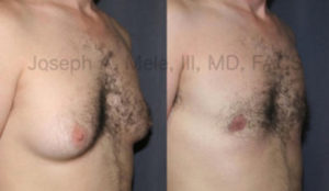 Gynecomastia reduction with liposuction and direct excision - before and after photos