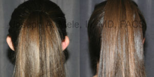 Female Otoplasty - ear pinning for prominent ears - before and after pictures