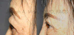 Upper Eyelid Lift before and after pictures (Upper Blepharoplasty)