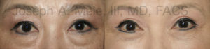 upper and lower eyelid lift before and after pictures (quad blepharoplasty)