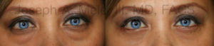 Lower blepharoplasty before and after pictures