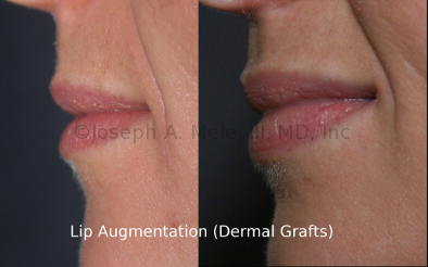 Dermal grafting offers a longer lasting Lip Augmentation. This type of Lip Enhancement is frequently combined with the Facelift.