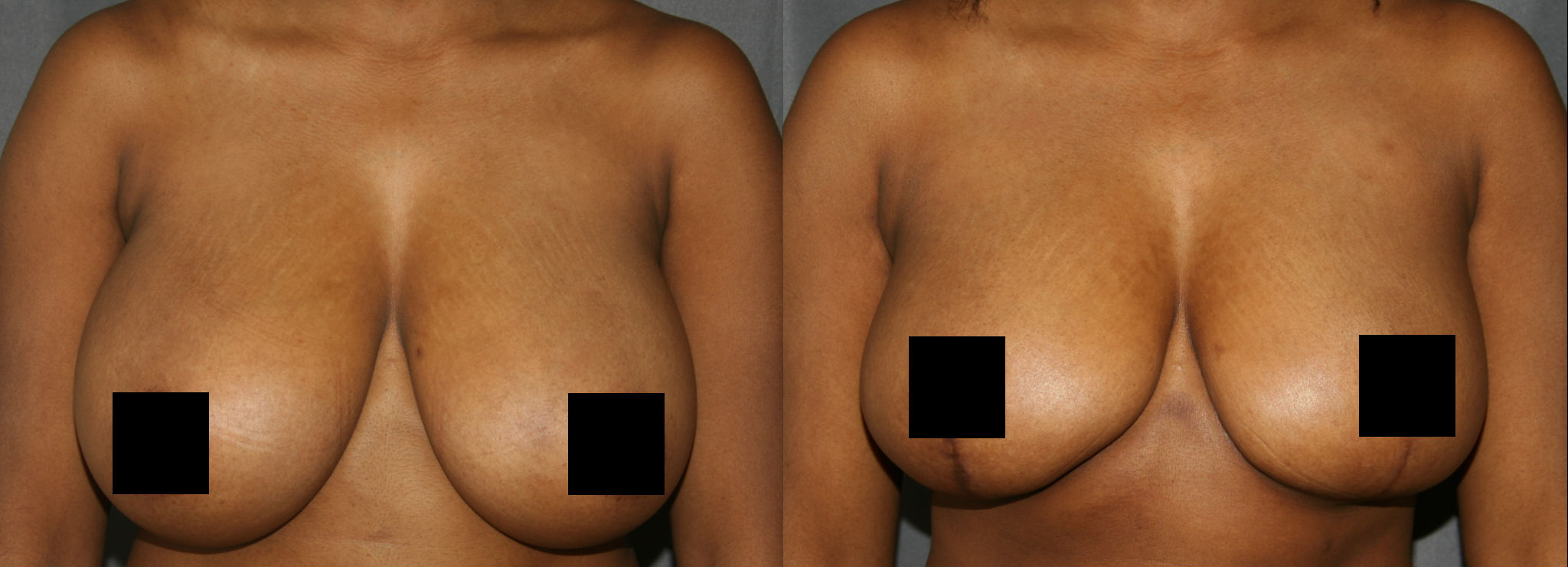 Breast Reduction Before and After Photos